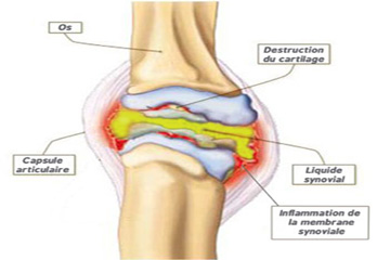 Arthritis Treatment in Pune