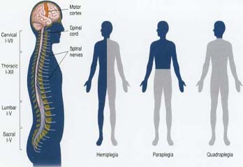 Paralysis Treatment in Pune