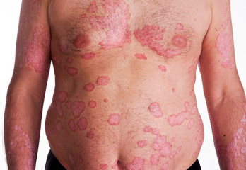 Psoriasis Treatment in Pune